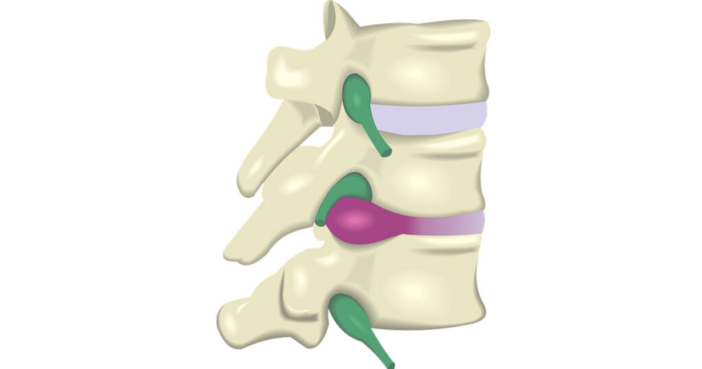 Herniated Disc Treatment