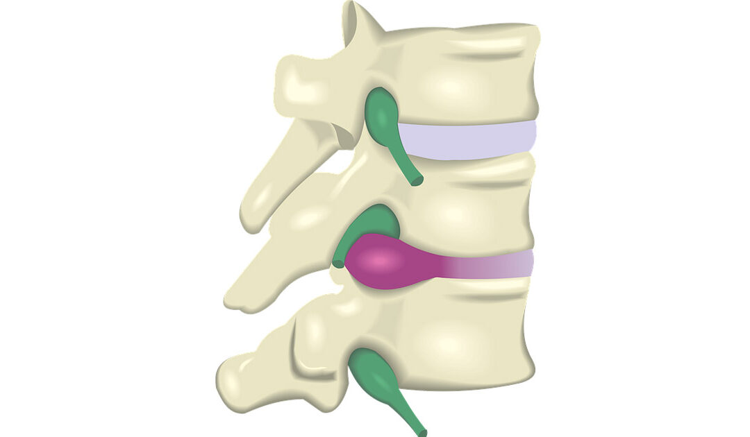 Herniated Disc Treatment