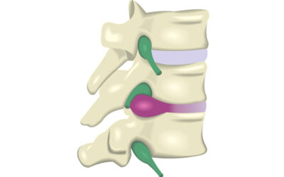 Herniated Disc Treatment